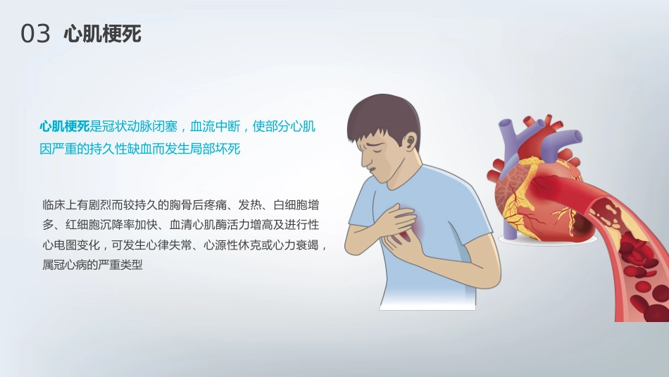 急性心肌梗死护理查房通用PPT_第14页