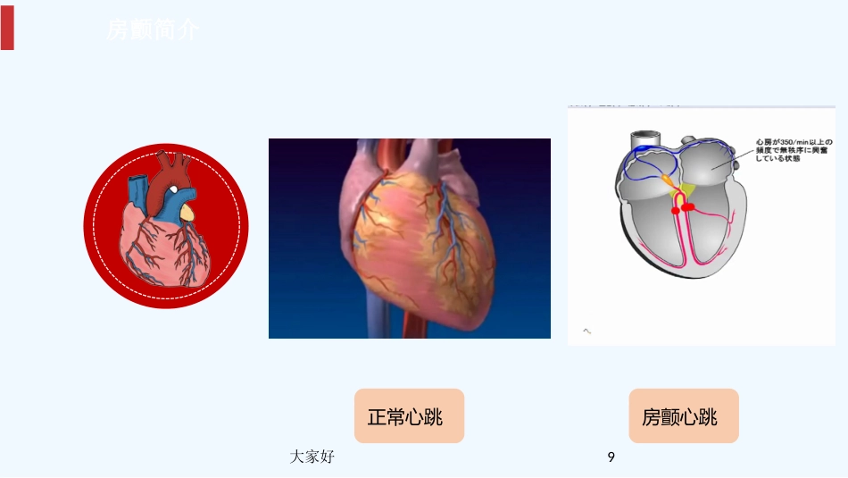 房颤健康宣教PPT_第9页