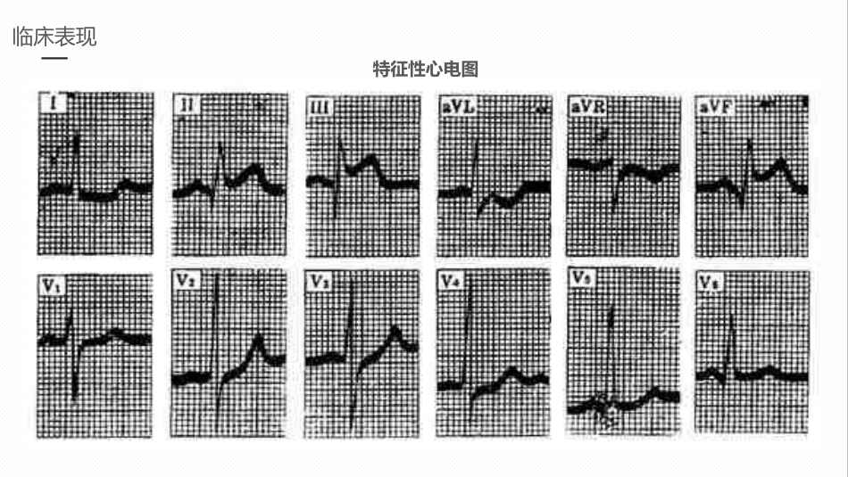 急性心梗的护理业务学习课件_第12页