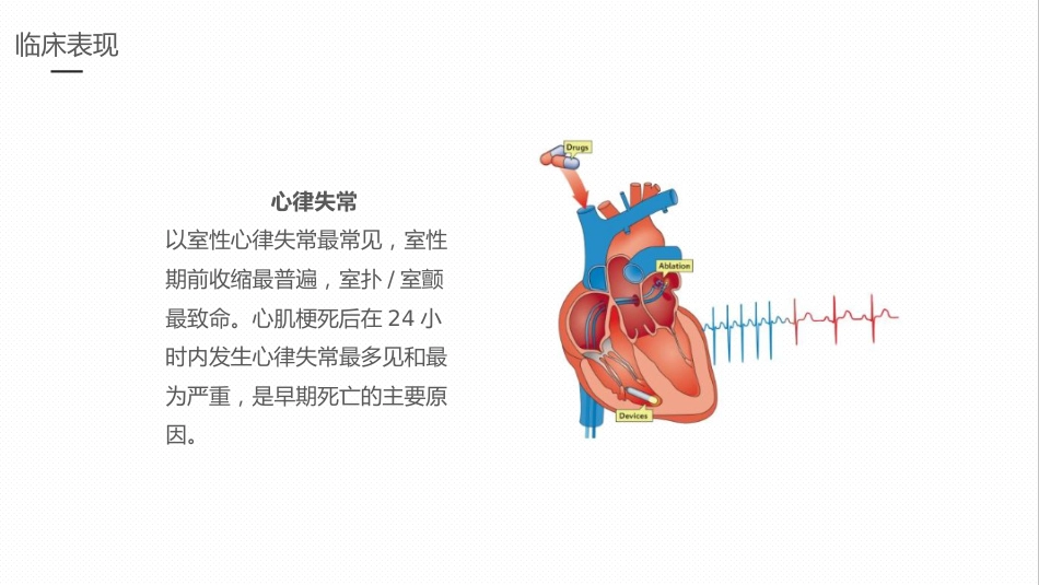急性心梗的护理业务学习课件_第9页