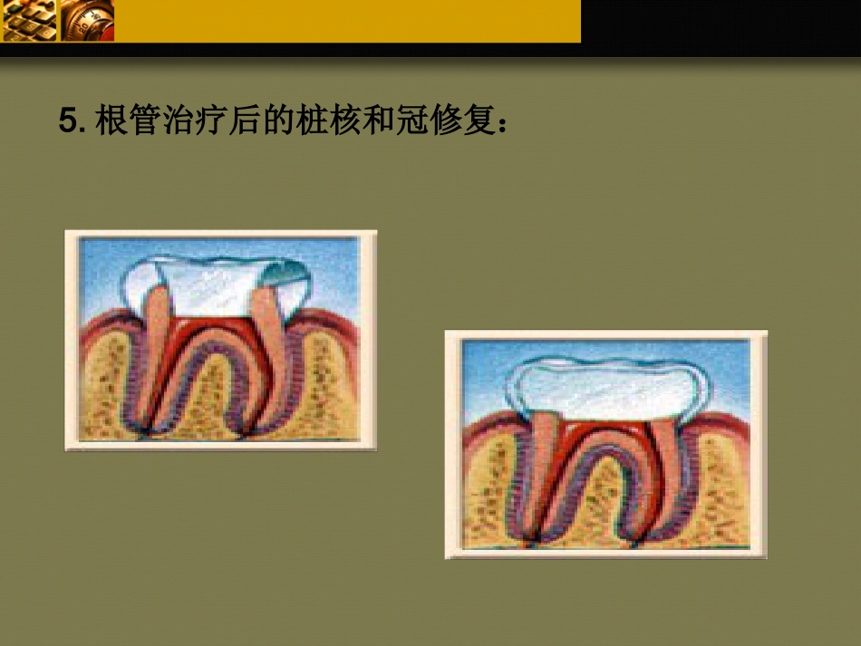 口腔培训103.牙科基本治疗内容介绍_第14页