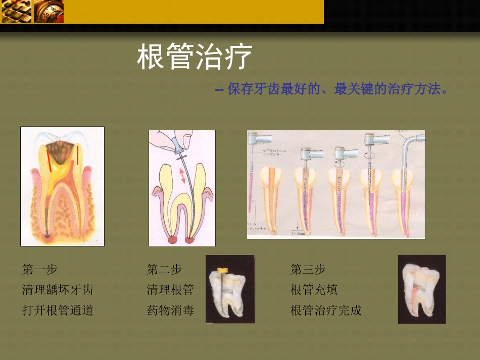 口腔培训103.牙科基本治疗内容介绍_第7页