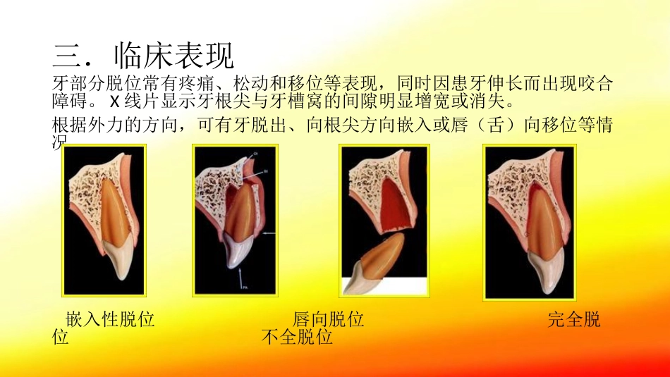 口腔培训104.牙脱位的检查、处理、处理后的口腔清洁_第5页