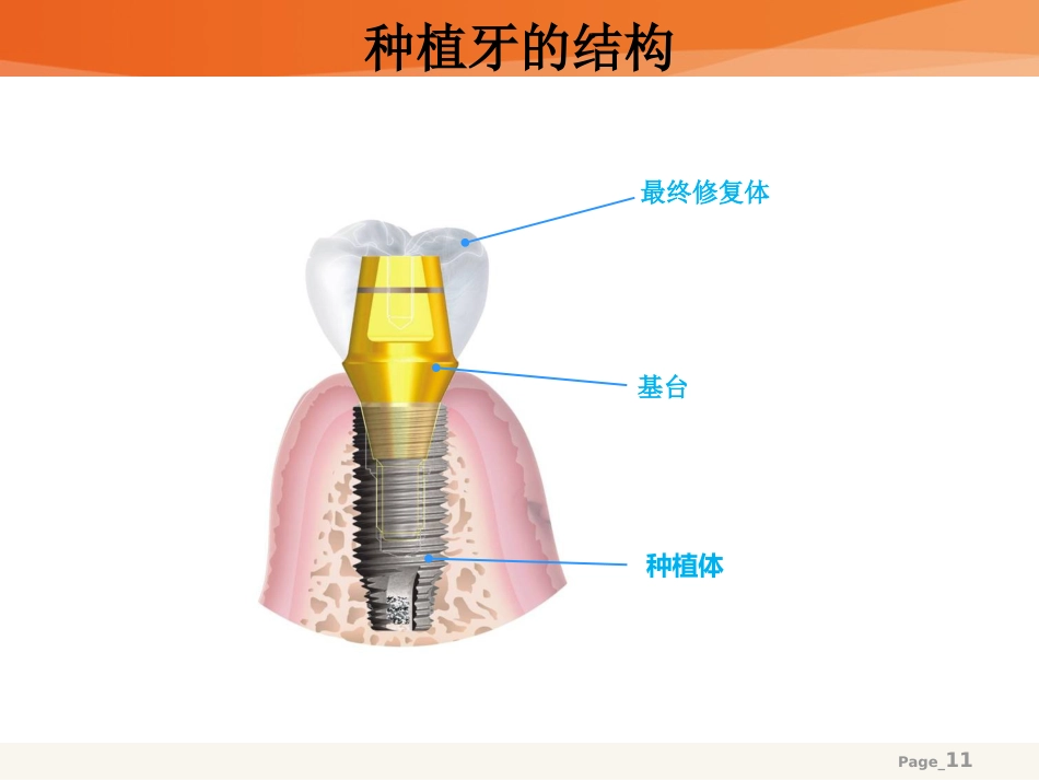 口腔培训111.种植牙基础_第11页
