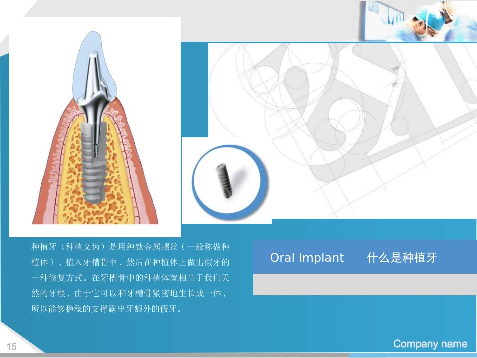 口腔培训112.种植牙讲座ppt演讲稿_第15页