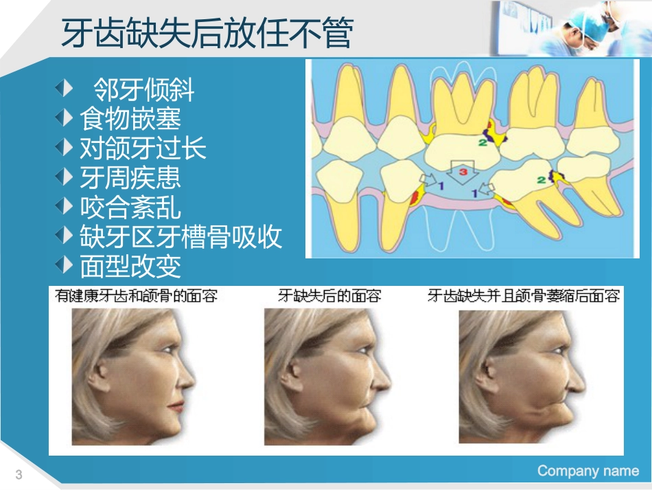 口腔培训112.种植牙讲座ppt演讲稿_第3页