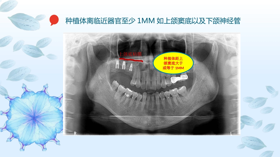 口腔培训113.种植选择_第2页