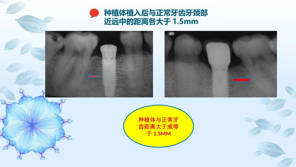 口腔培训113.种植选择_第5页