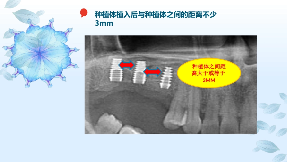 口腔培训113.种植选择_第6页