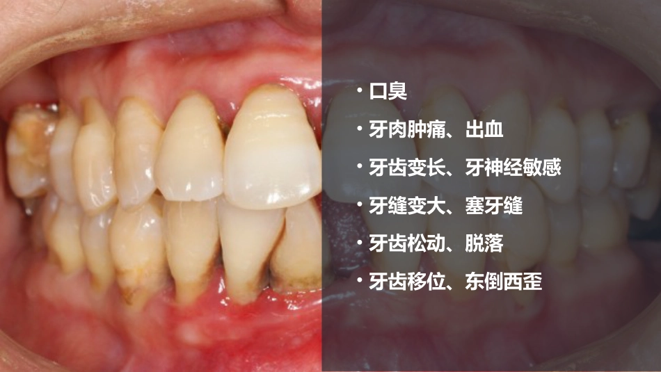口腔培训115.为什么要洁牙（医生版）_第4页