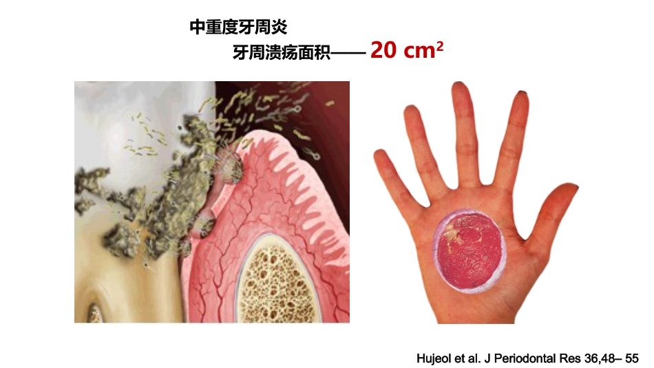 口腔培训115.为什么要洁牙（医生版）_第6页