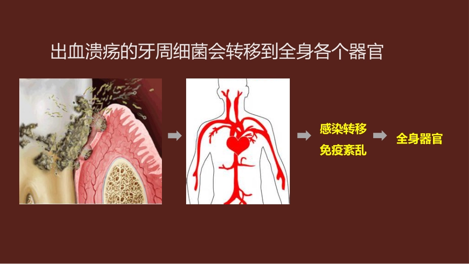 口腔培训115.为什么要洁牙（医生版）_第7页
