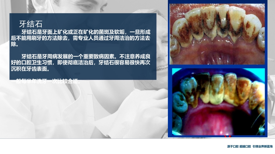 口腔培训117.牙周治疗_第5页