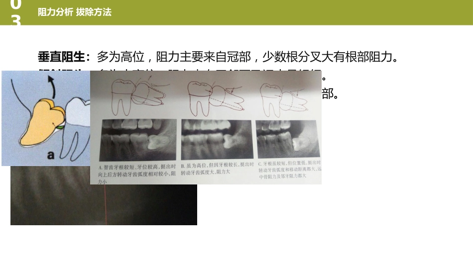 口腔培训126.阻生牙_第11页