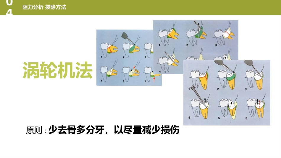 口腔培训126.阻生牙_第12页