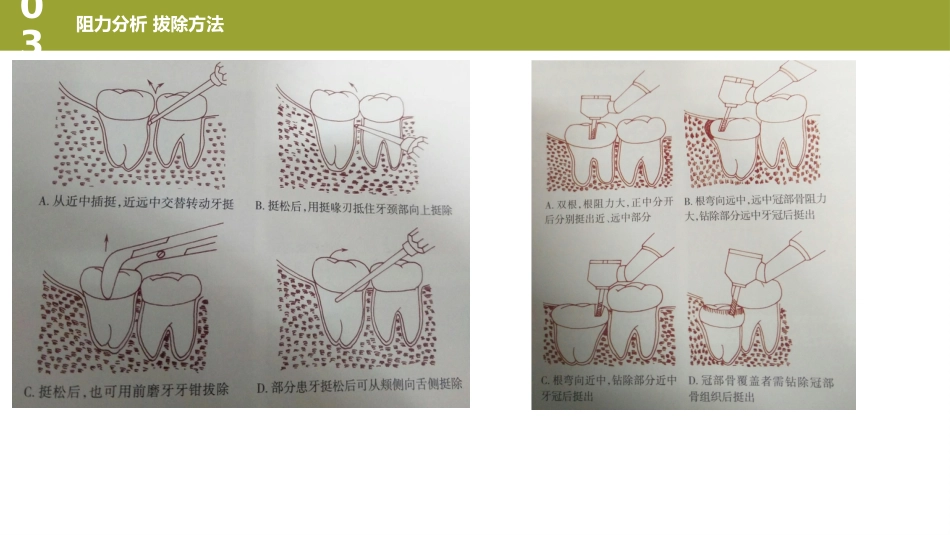 口腔培训126.阻生牙_第13页