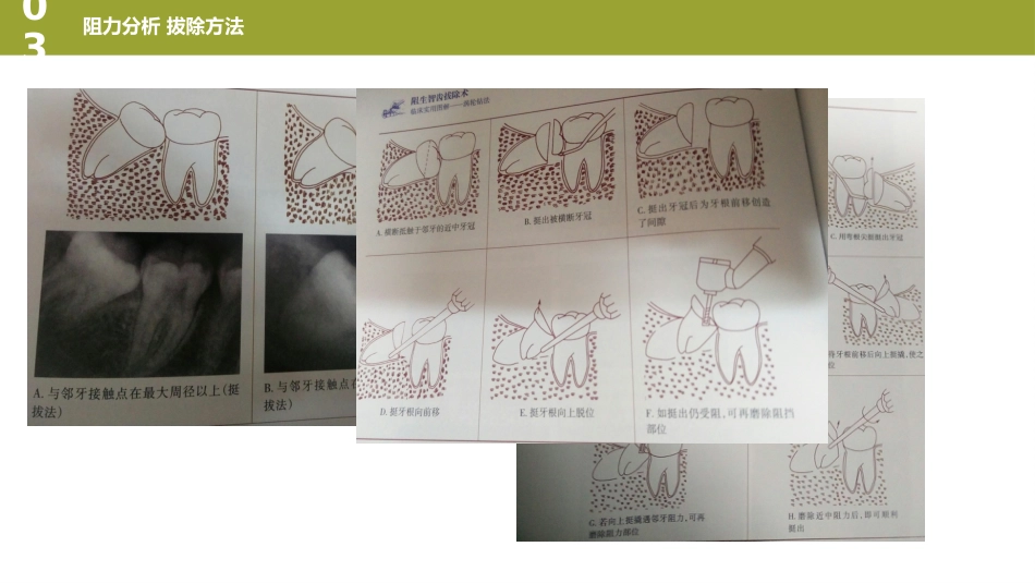 口腔培训126.阻生牙_第14页