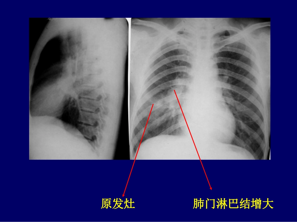 -C胸部影像结核_第11页