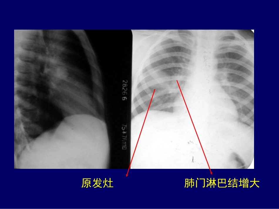 -C胸部影像结核_第12页