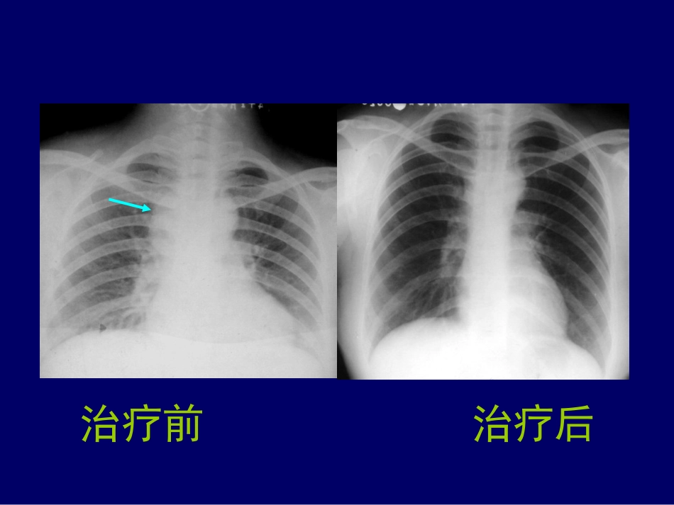 -C胸部影像结核_第13页