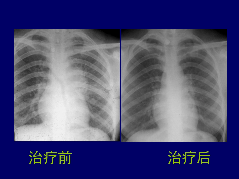-C胸部影像结核_第14页