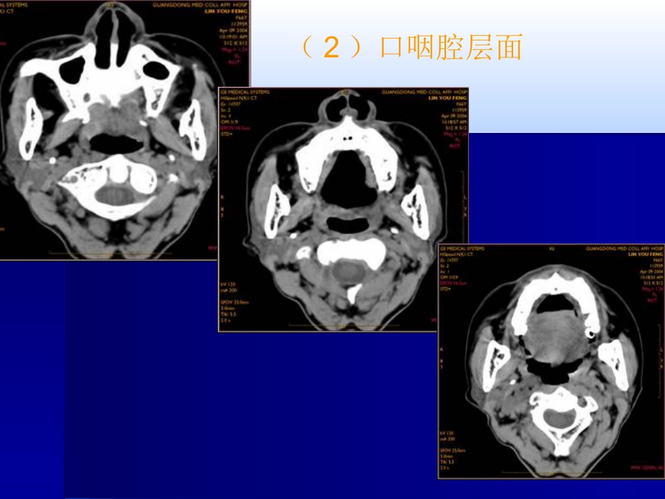 咽喉影像诊断学_第11页