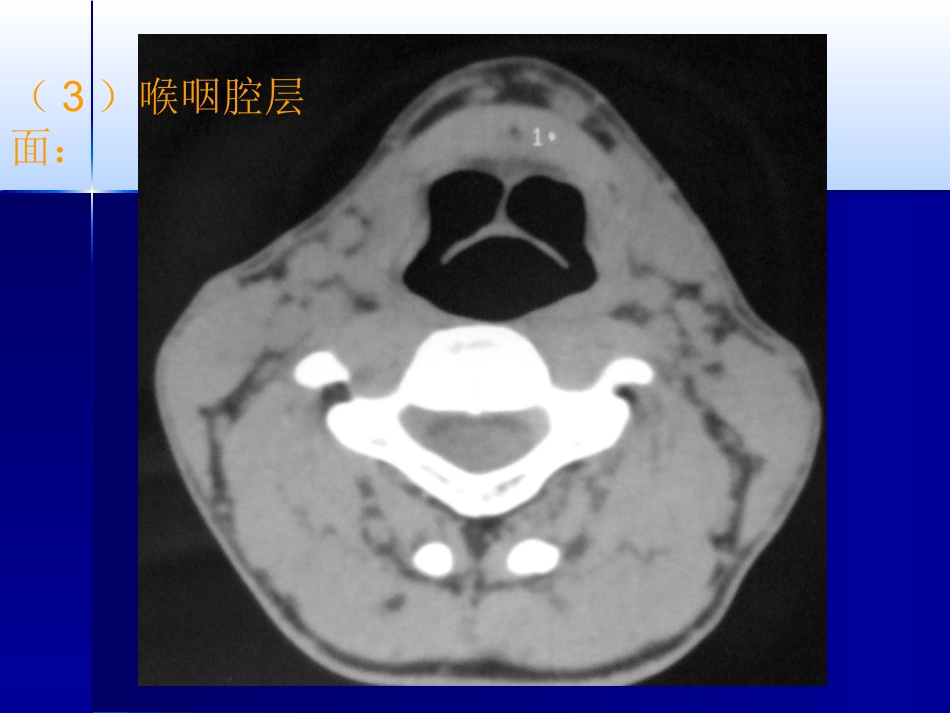 咽喉影像诊断学_第12页