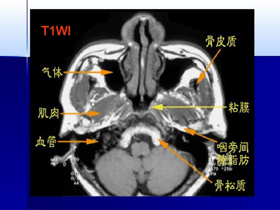 咽喉影像诊断学_第15页