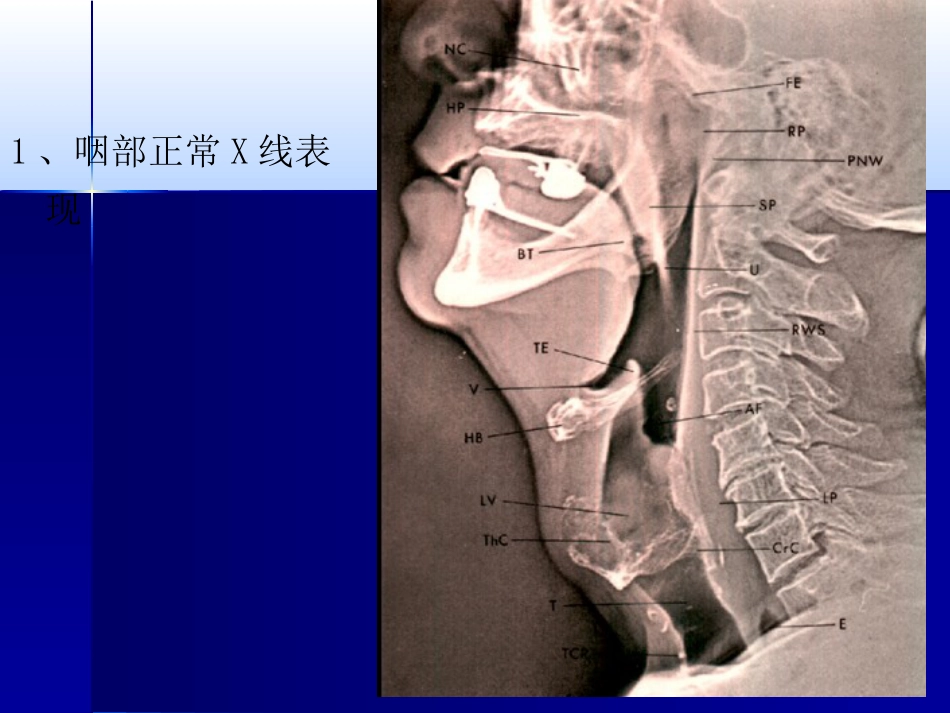 咽喉影像诊断学_第7页