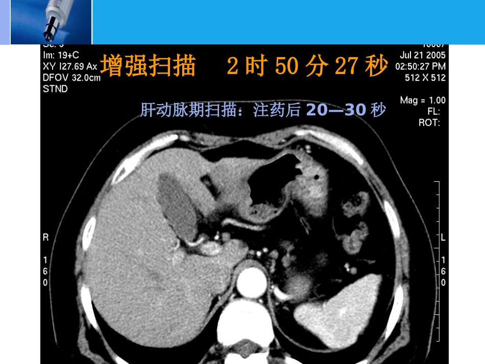 肝脏的CT影像诊断_第15页