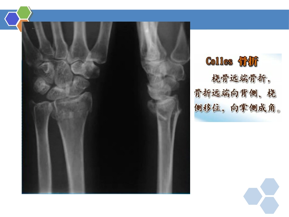 四肢骨折-影像诊断_第13页