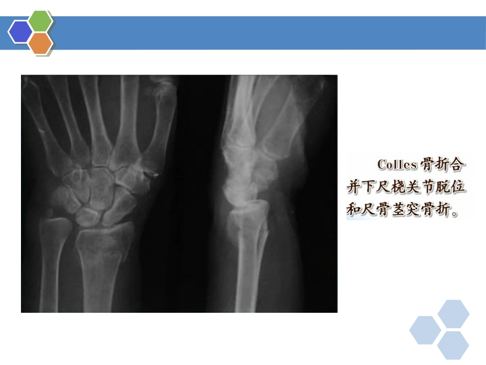 四肢骨折-影像诊断_第14页