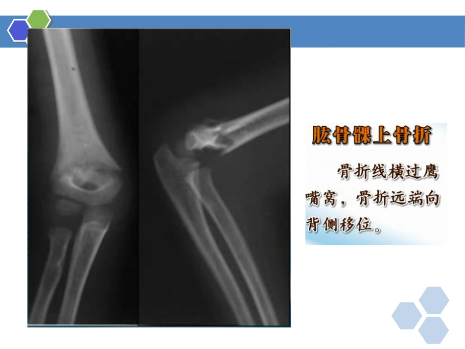 四肢骨折-影像诊断_第7页