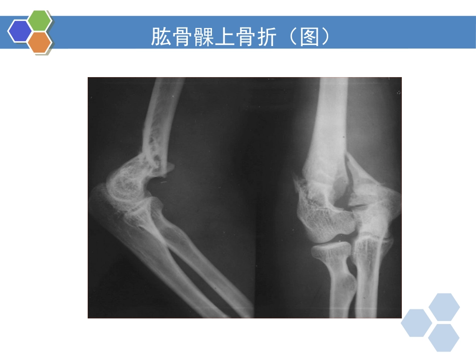 四肢骨折-影像诊断_第9页