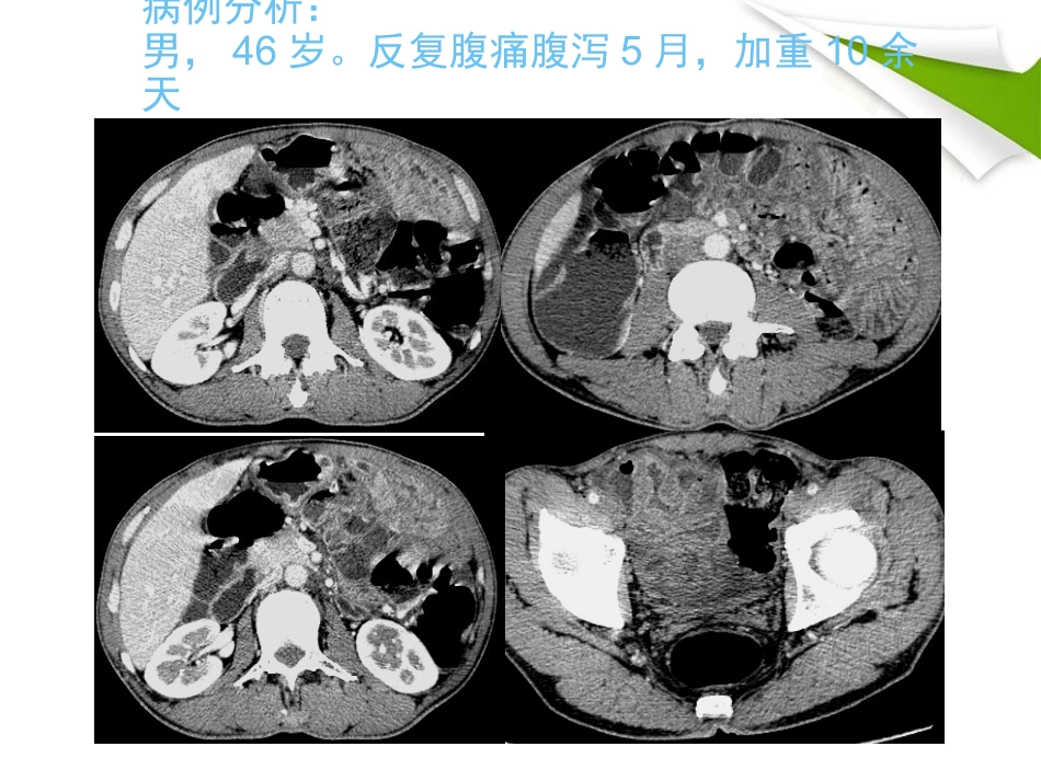 缺血性肠病的影像诊断_第1页