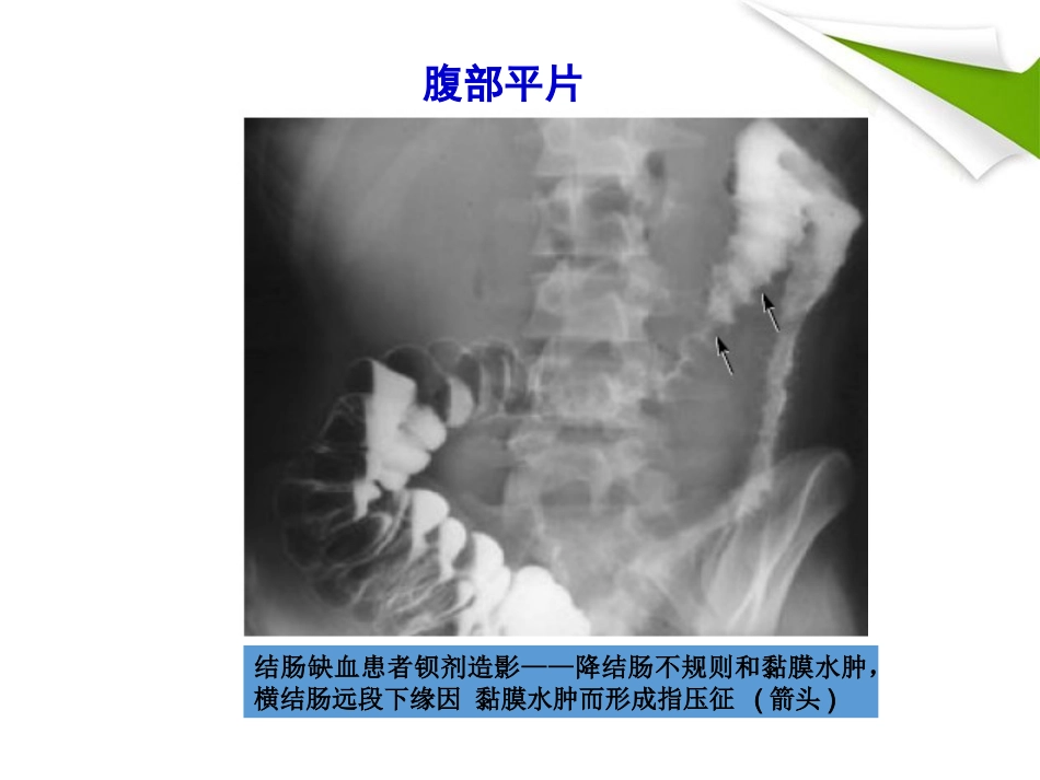缺血性肠病的影像诊断_第10页