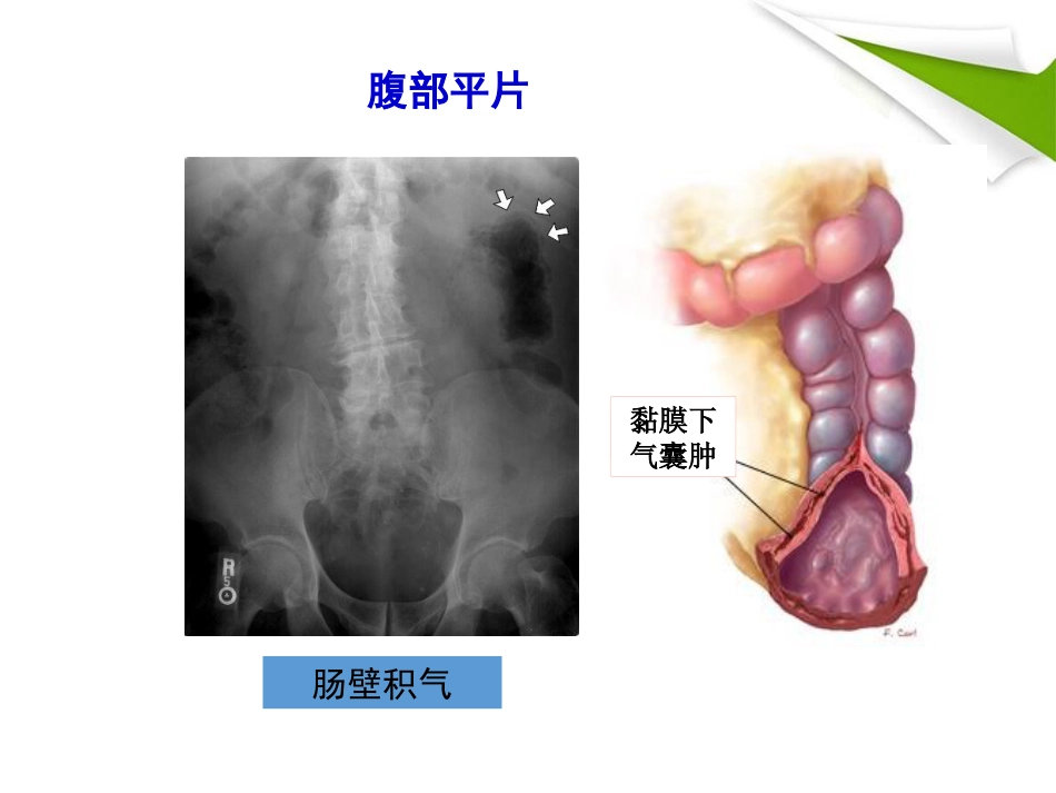 缺血性肠病的影像诊断_第11页