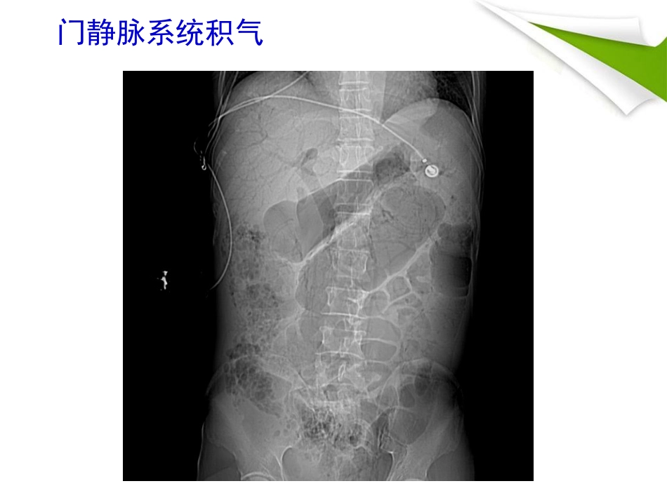 缺血性肠病的影像诊断_第12页