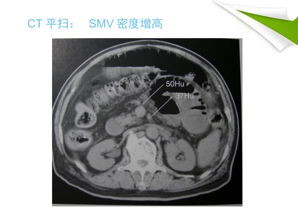 缺血性肠病的影像诊断_第14页