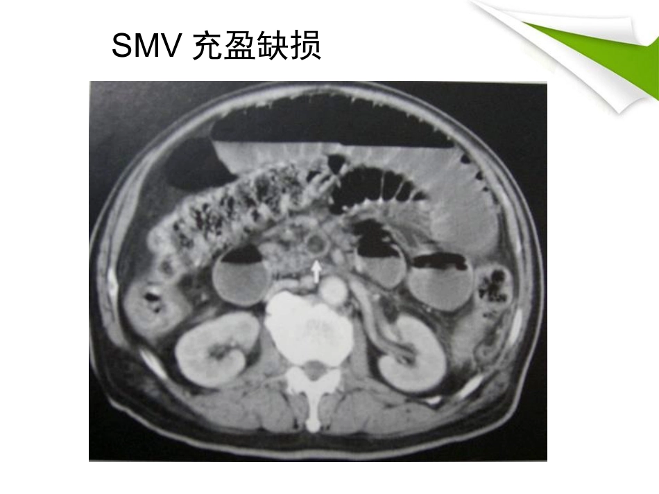 缺血性肠病的影像诊断_第15页