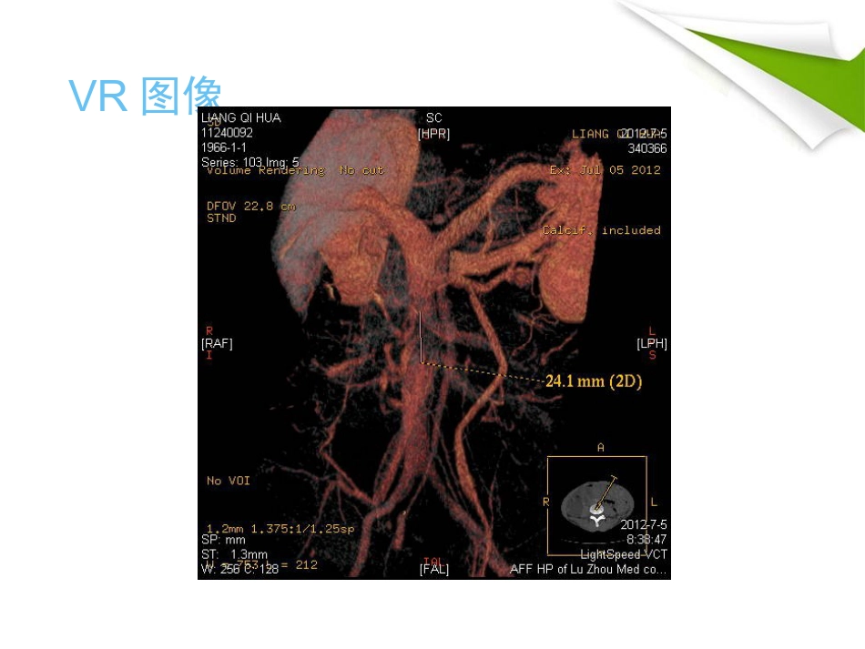 缺血性肠病的影像诊断_第3页
