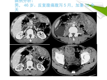 缺血性肠病的影像诊断