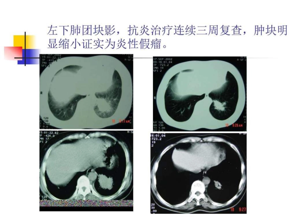 医学影像学 (肺部)_第12页