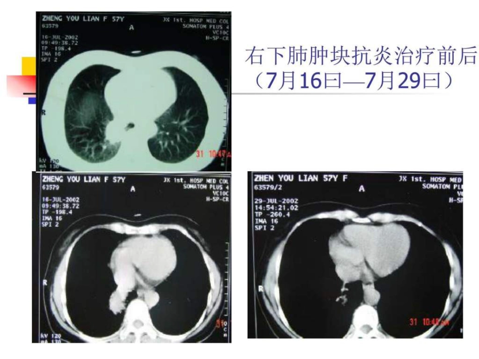 医学影像学 (肺部)_第13页
