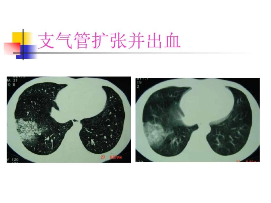 医学影像学 (肺部)_第4页