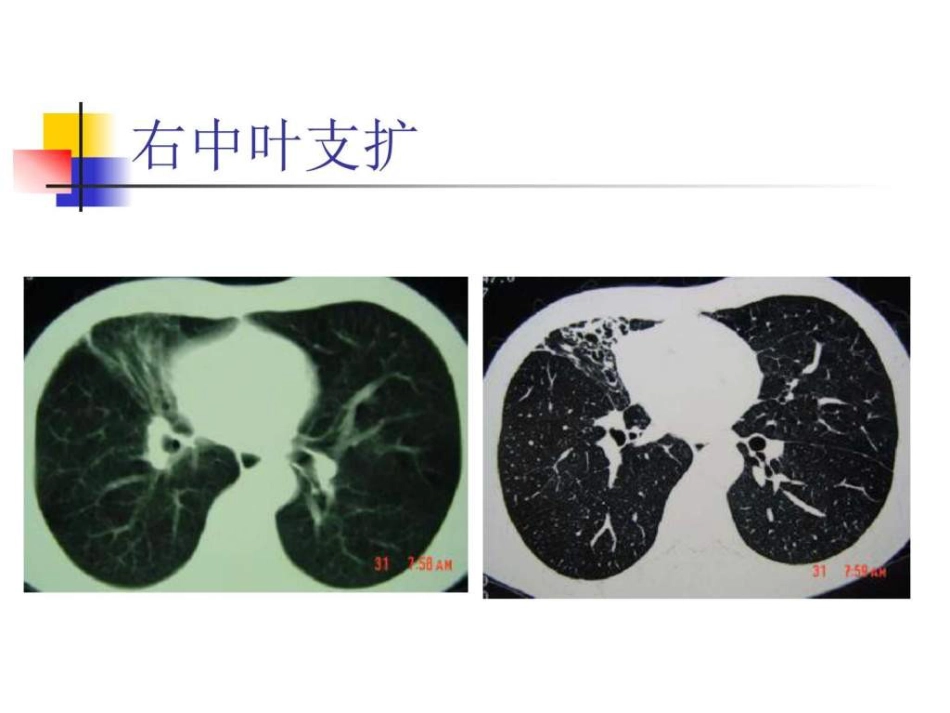 医学影像学 (肺部)_第5页