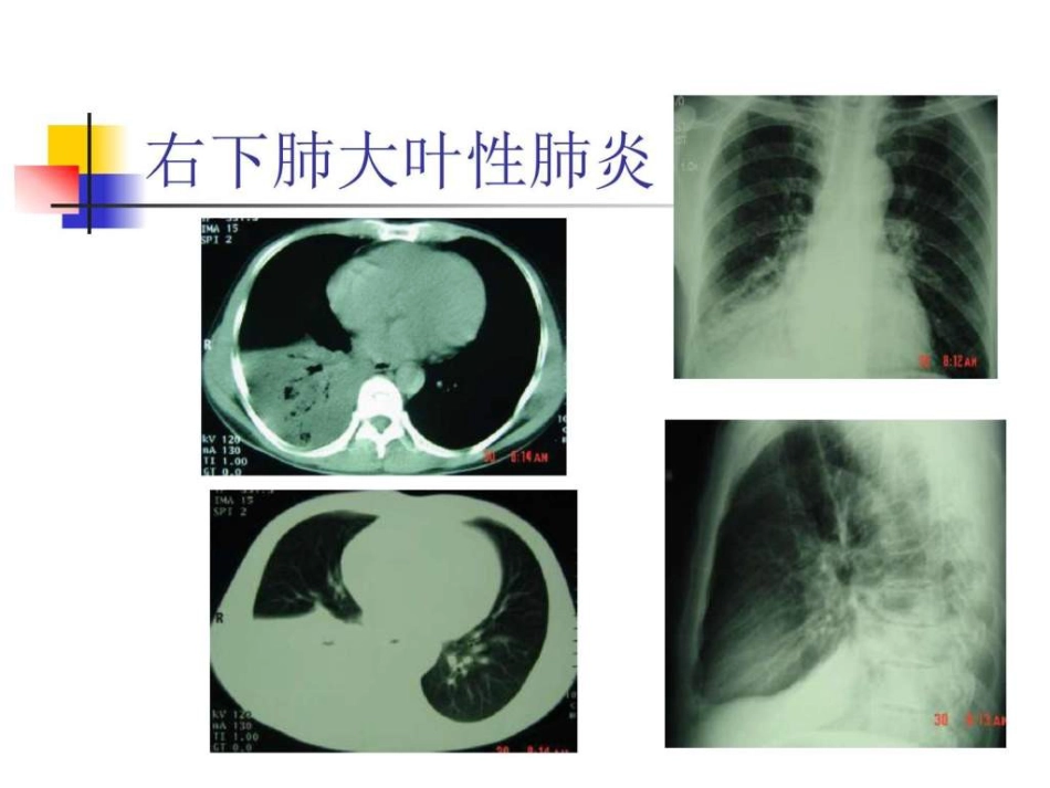 医学影像学 (肺部)_第9页