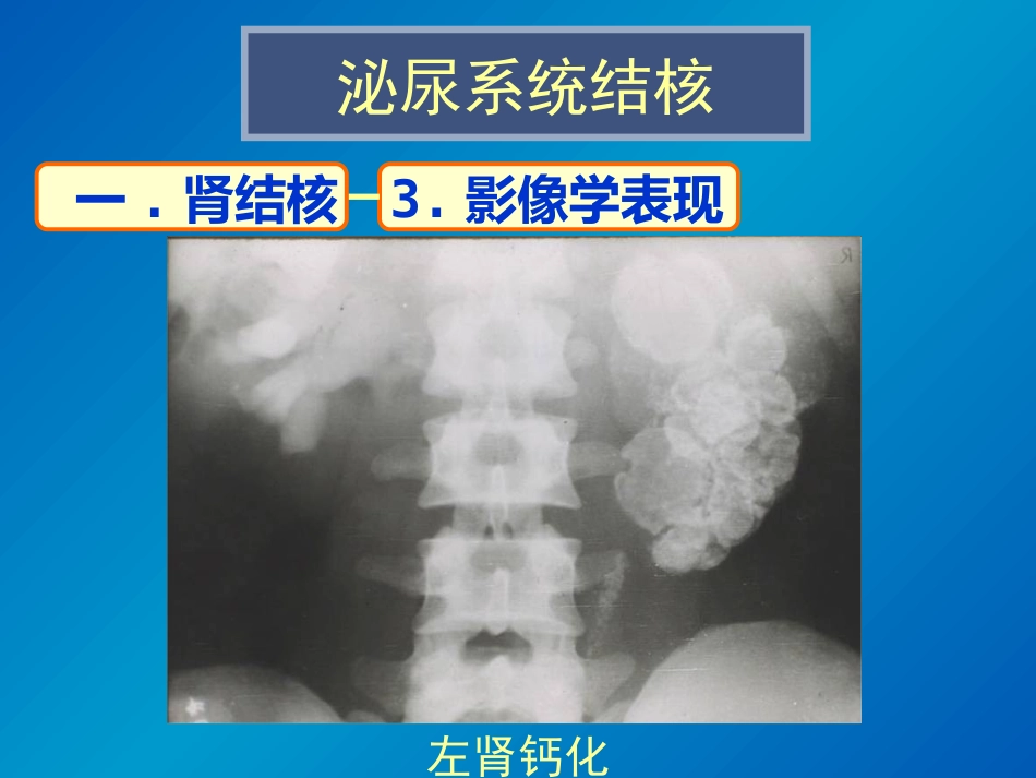 泌尿系统感染影像诊断_第10页