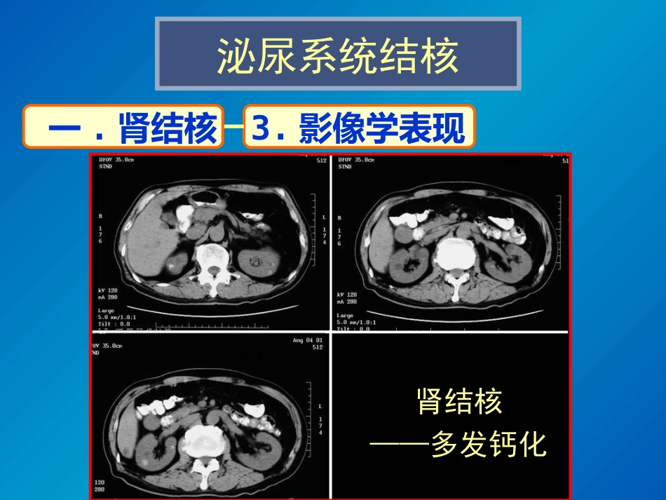 泌尿系统感染影像诊断_第12页