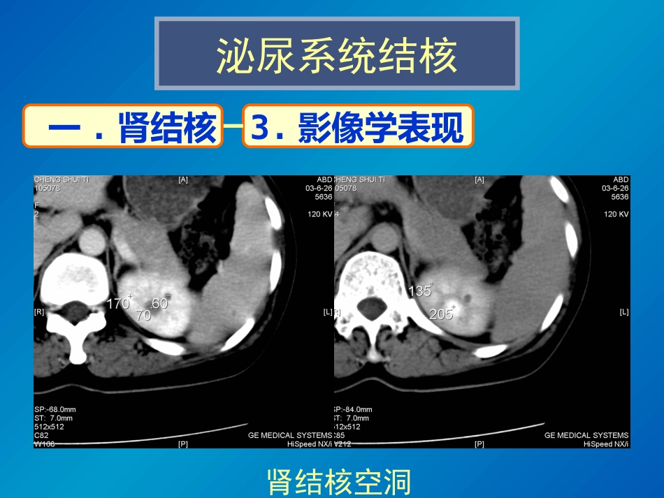 泌尿系统感染影像诊断_第13页